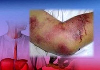 فوت یک هرمزگانی از تب کنگو/ شناسایی ۱۰ مورد مشکوک در یزد