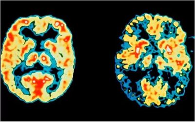 روشی برای تشخیص آلزایمر ۷ سال پیش از ابتلا