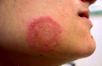 مراقب قارچ‌های رنگارنگ  پوست باشیم