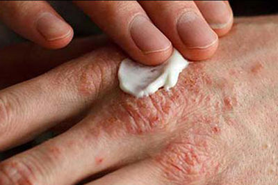 راهکارهای درمانی اگزمای پوست