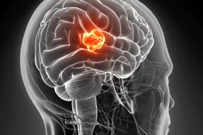 ۵ نشانه تومور مغزی که نباید نادیده گرفته شوند