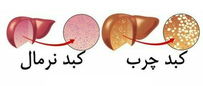 با داشتن این علائم به کبد چرب مبتلا هستید