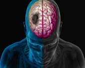 شایع ترین علائم سکته مغزی