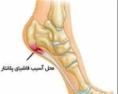 ۷ نکته که باید درباره خار پاشنه پا بدانید
